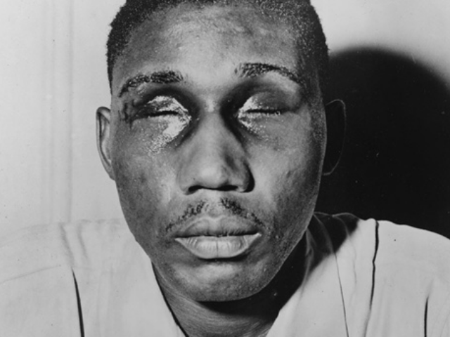 Black and white photograph of Isaac Woodard with eyes swollen shut